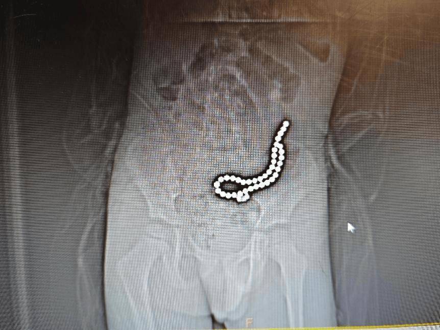 整整37颗！云南4岁孩子身体里取出……医生紧急提醒！