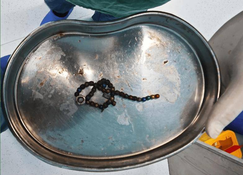 整整37颗!云南4岁孩子身体里取出……医生紧急提醒!
