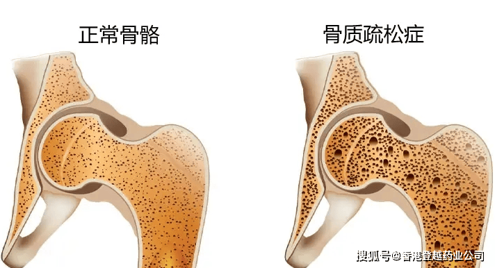 治疗骨质疏松：地舒单抗 Conexxence (denosumab-bnht)